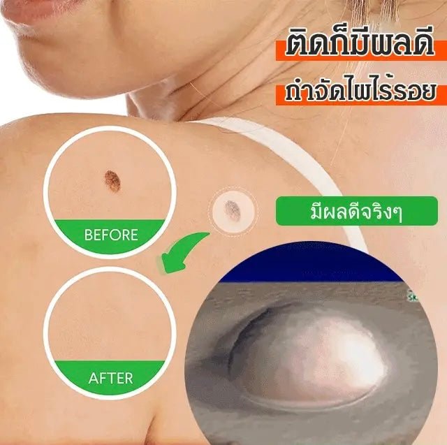 Traceless mole removal stickers - Denna
