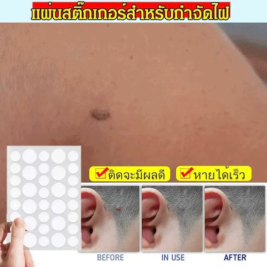 Traceless mole removal stickers